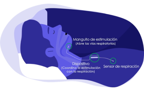 Cómo funciona el dispositivo Inspire para la apnea del sueño
