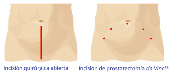 3_Incision_Comparison_Prostatectomy_gl600w.jpg