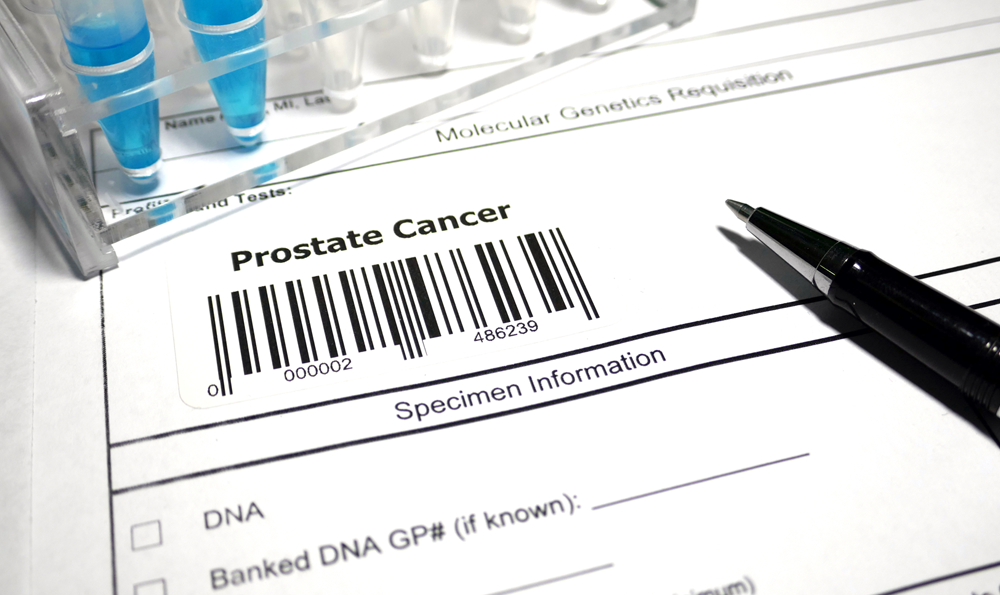 Prostate cancer test result