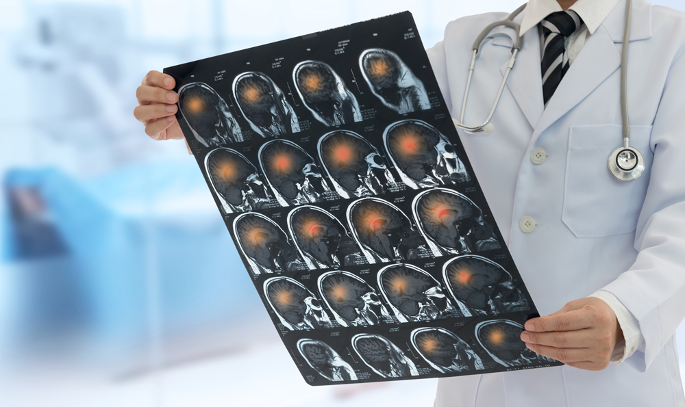 A physician examines a brain scan.