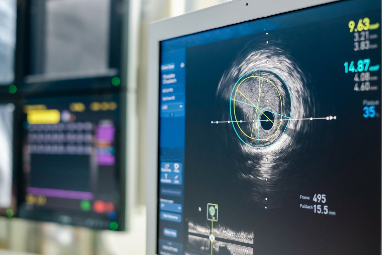 Intravascular ultrasound imaging (IVUS) at cardiac catheterization laboratory room.